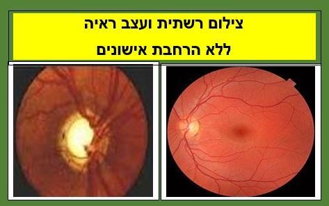 צילום רשתית ועצב ראיה