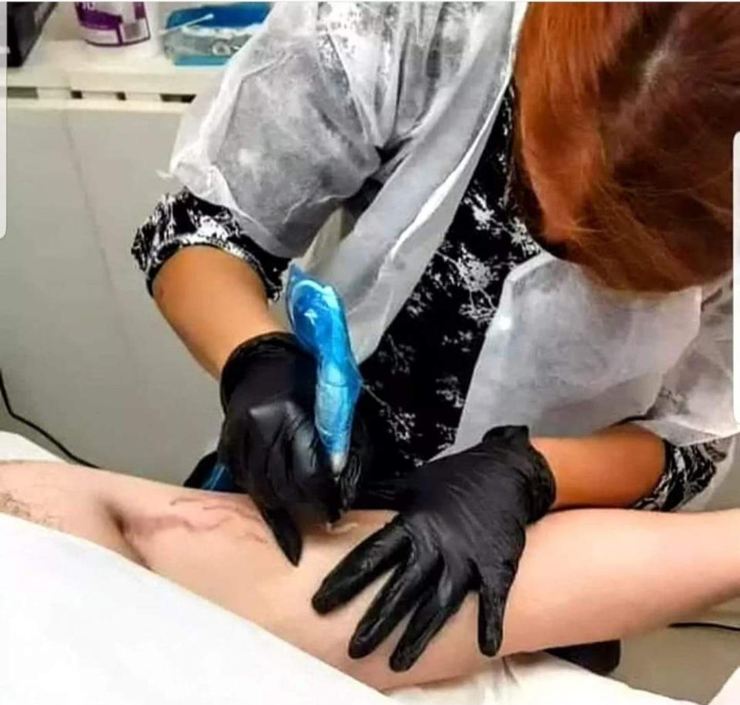 הסוואת סימני מתיחה כתוצאה מפיתוח גוף